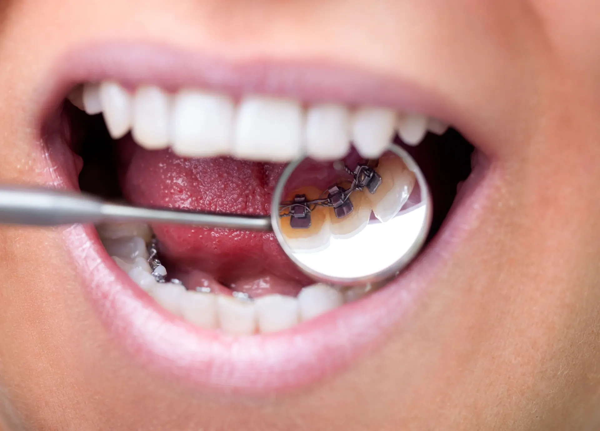Cosmetic Dentistry in Campbell, CA