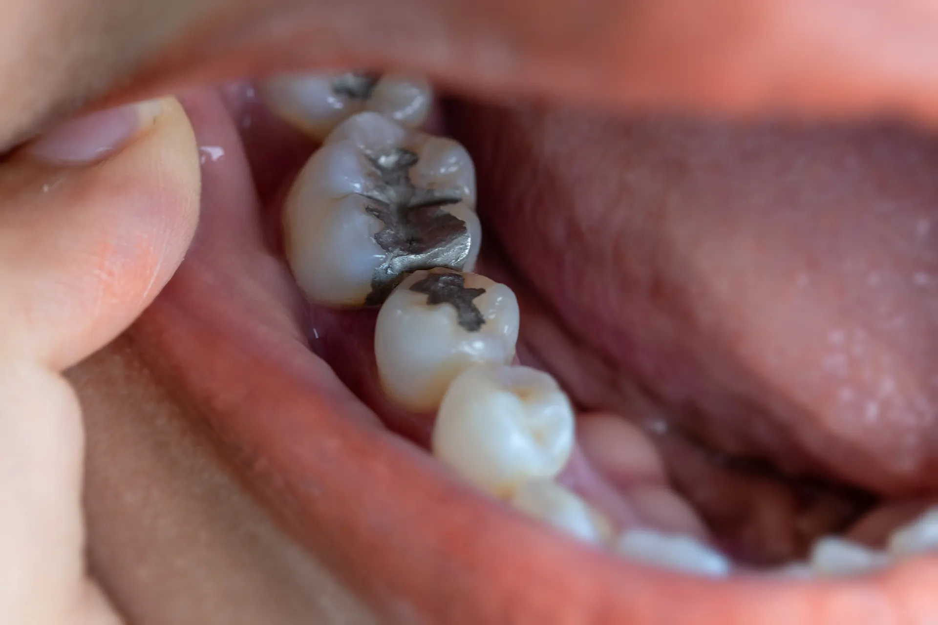 Composite Dental Fillings