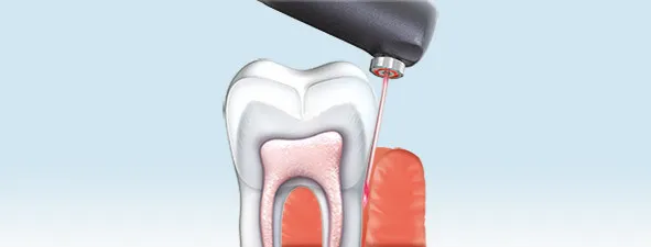 Questions About DIAGNOdent?