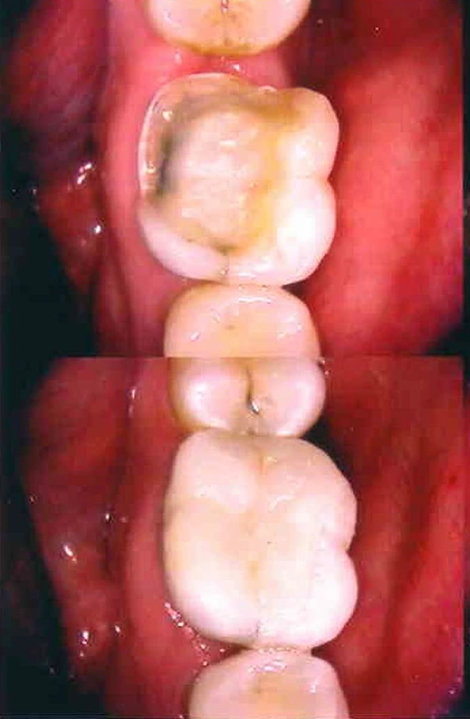 Before and after smile transformation