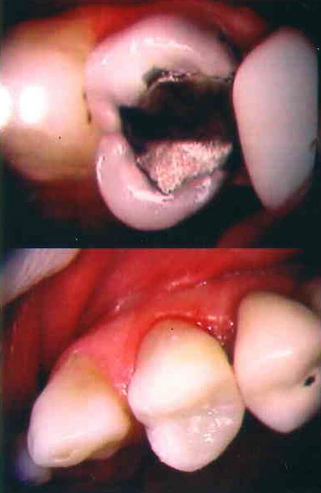 Before and after smile transformation