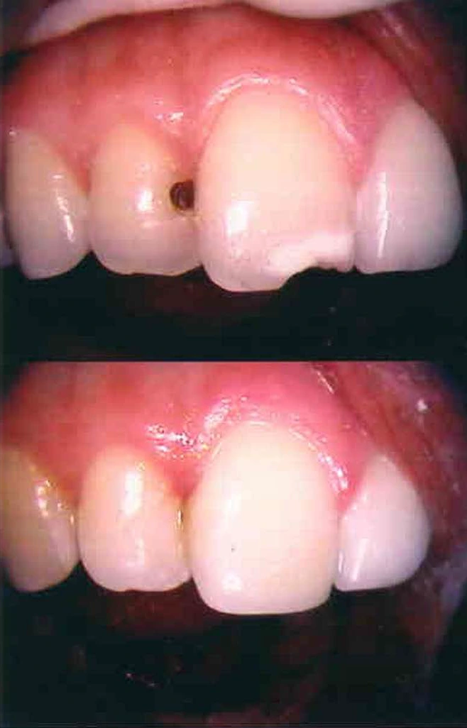 Before and after smile transformation