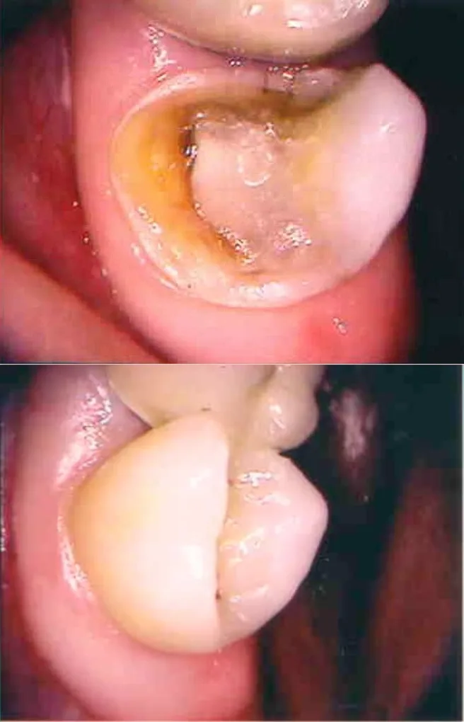 Before and after smile transformation