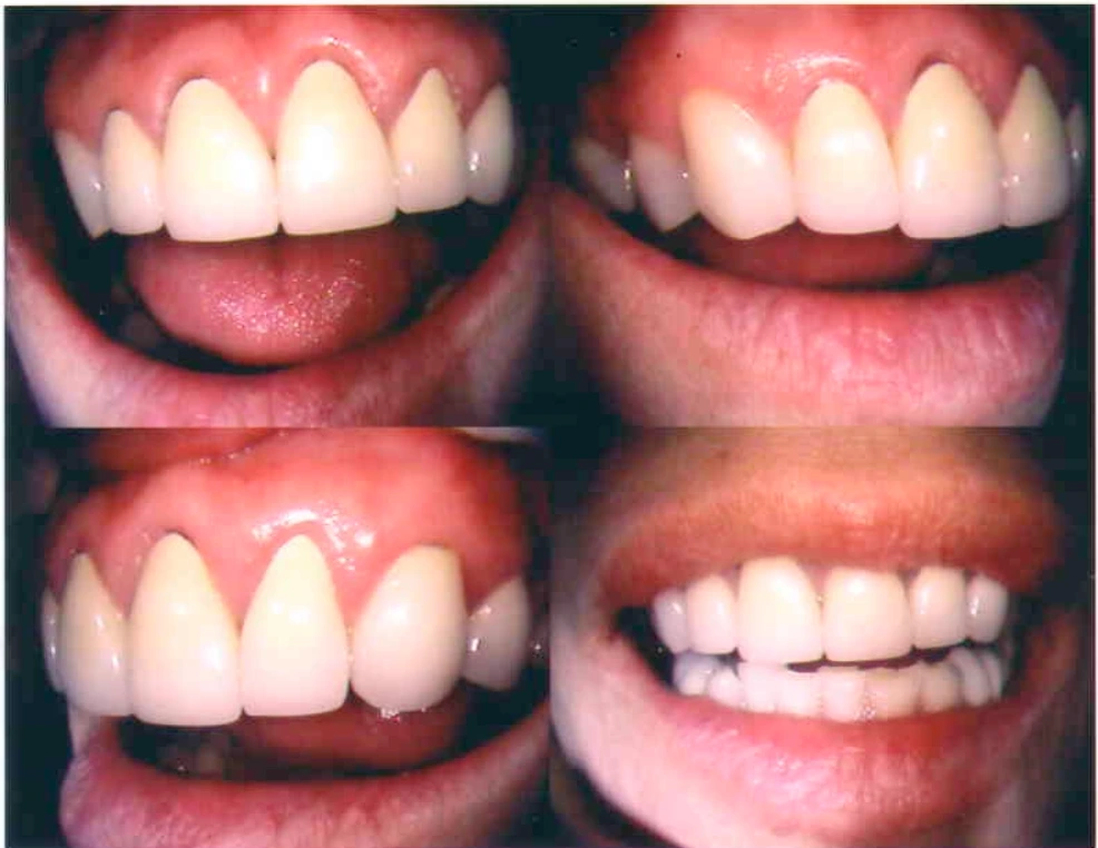 Pre-procedure smile photo