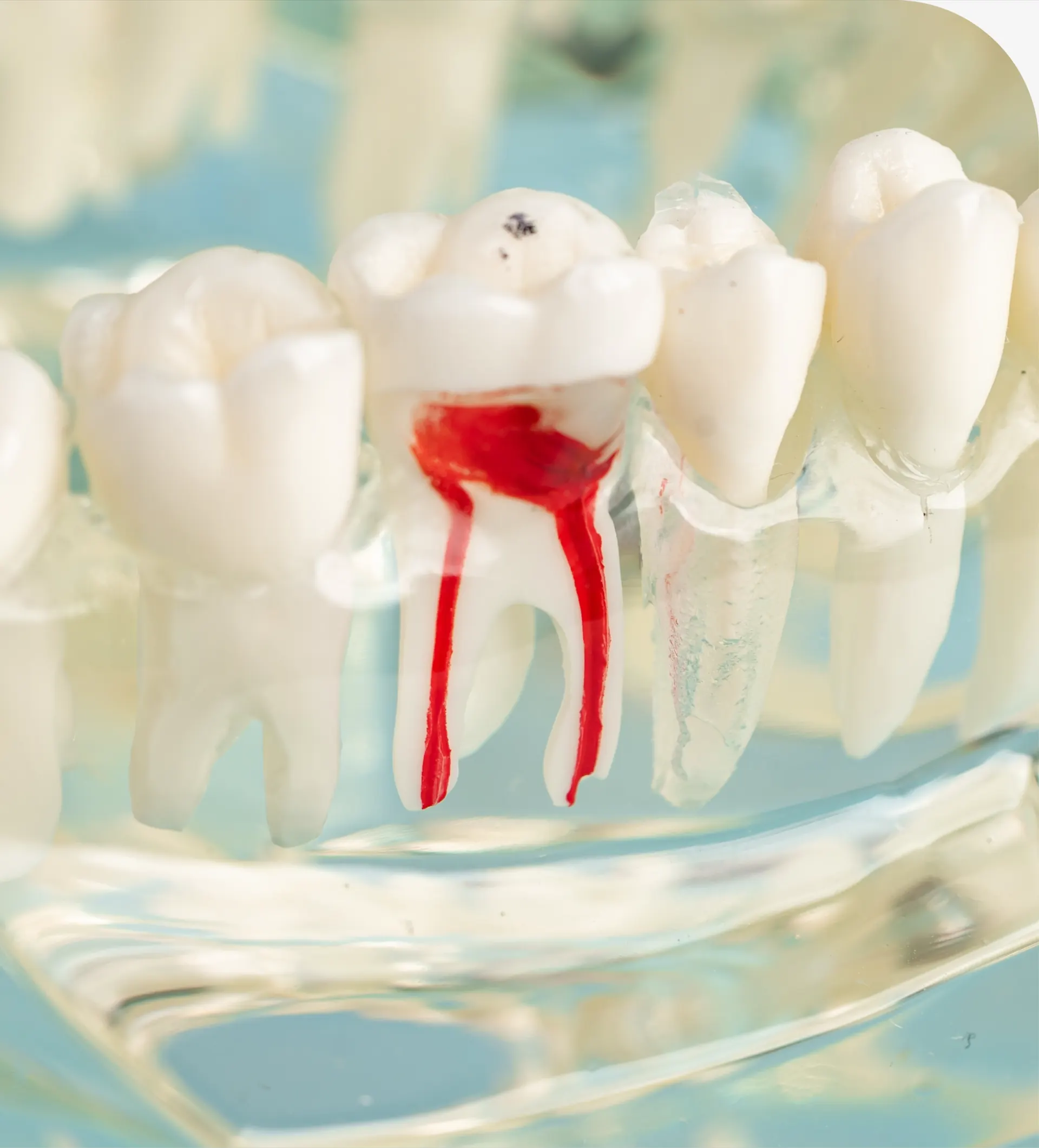 Questions About Root Canal Therapy?